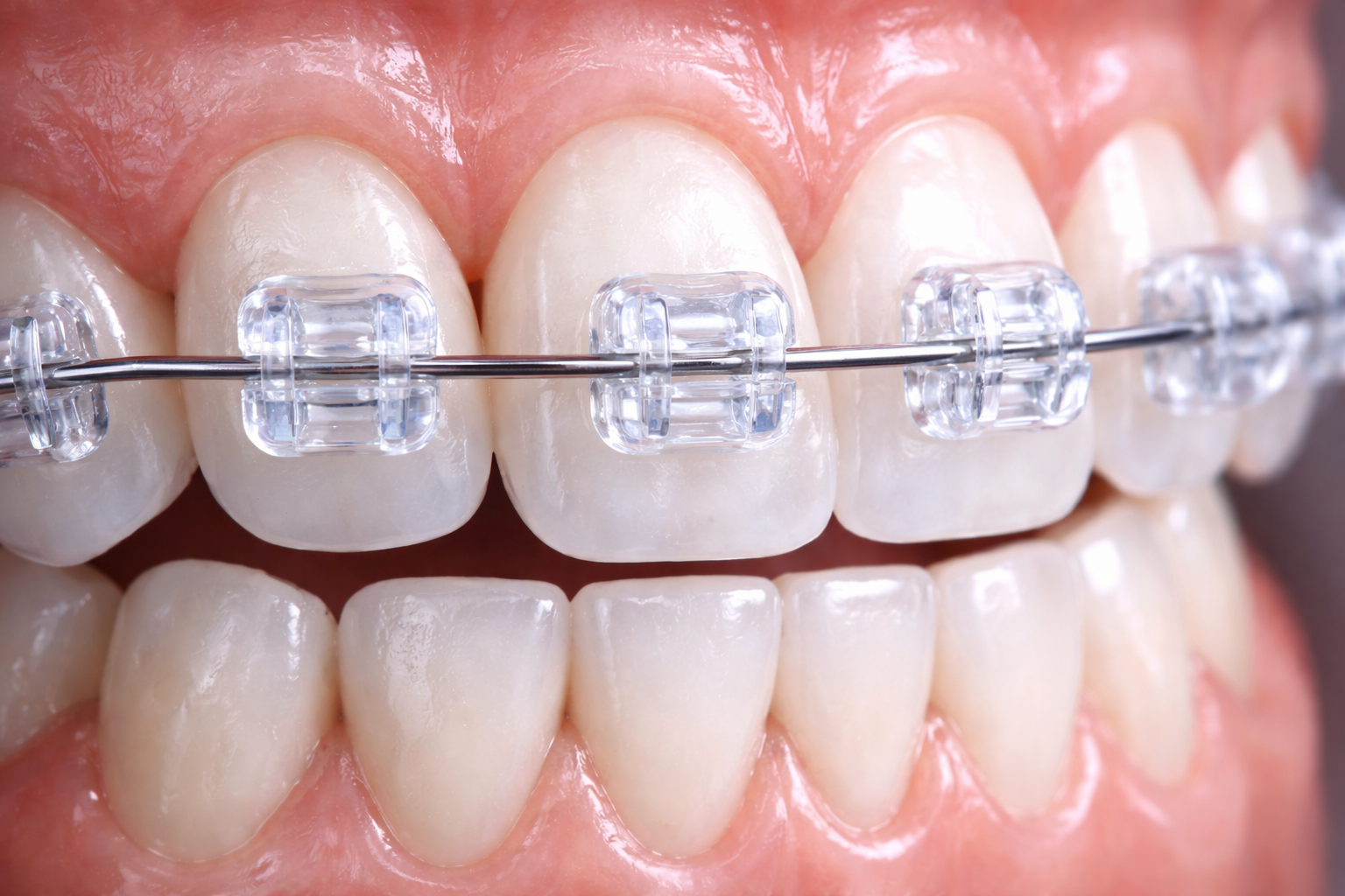 Monocrystalline Ceramic Braces Staining Myths Debunked